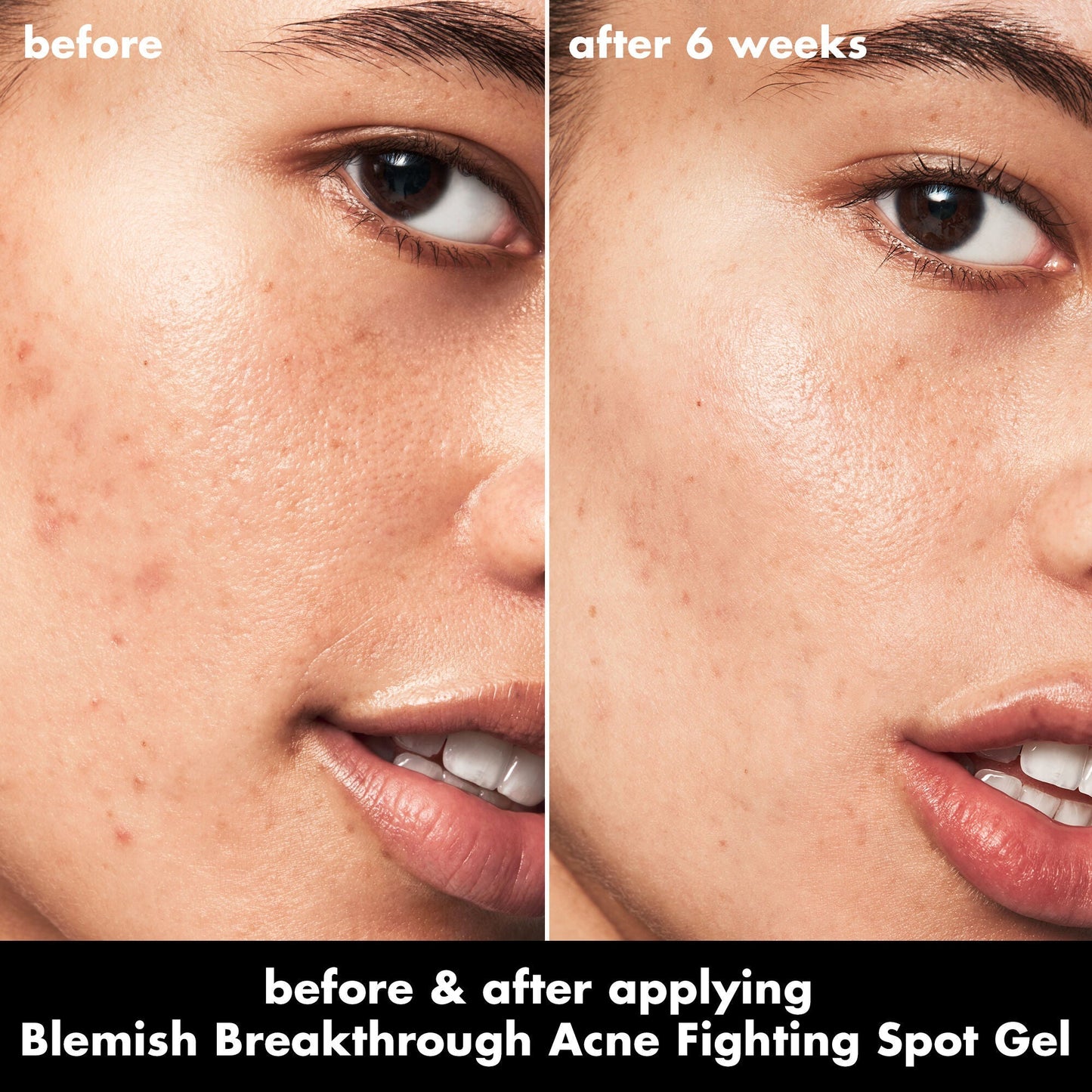 blemish-breakthrough-acne-fighting-spot-gel-a6 0326_EDU_BB_SpotGel_BA_ISABELLA.jpg