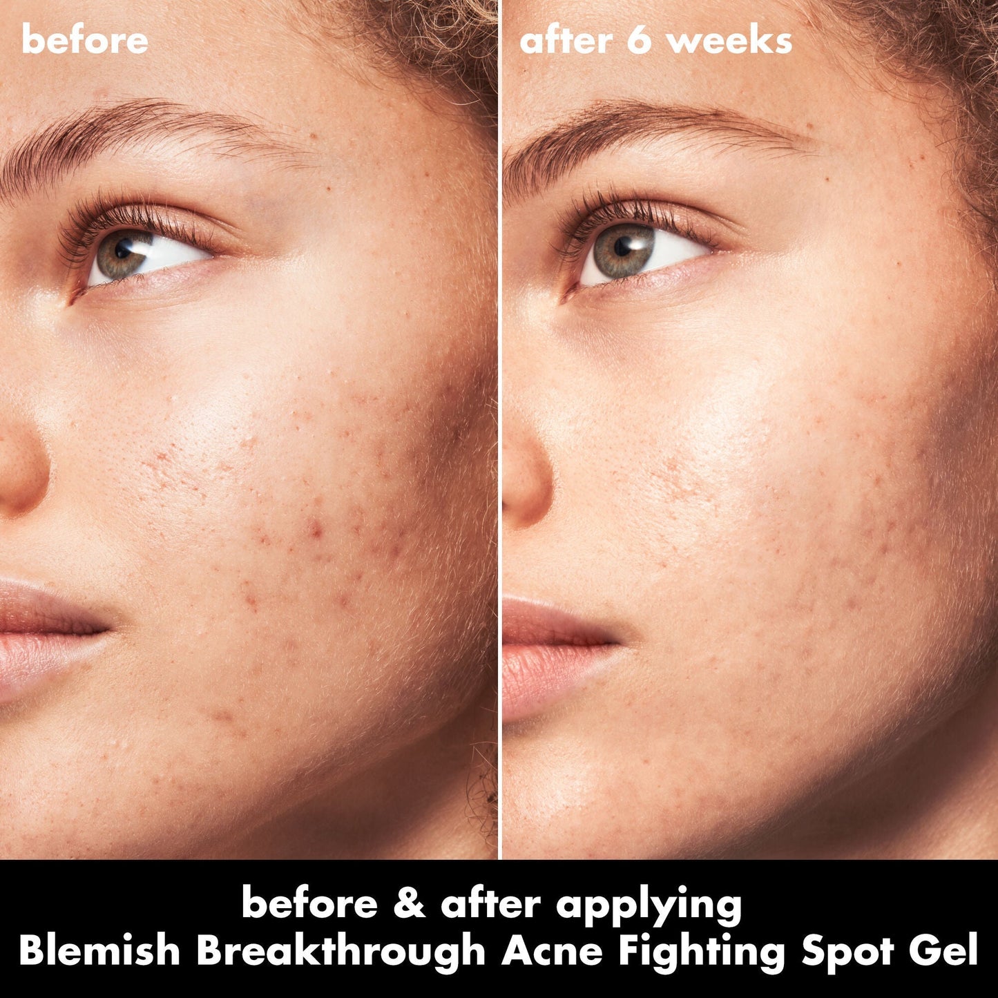 blemish-breakthrough-acne-fighting-spot-gel-a6 0326_EDU_BB_SpotGel_BA_MARLEY.jpg