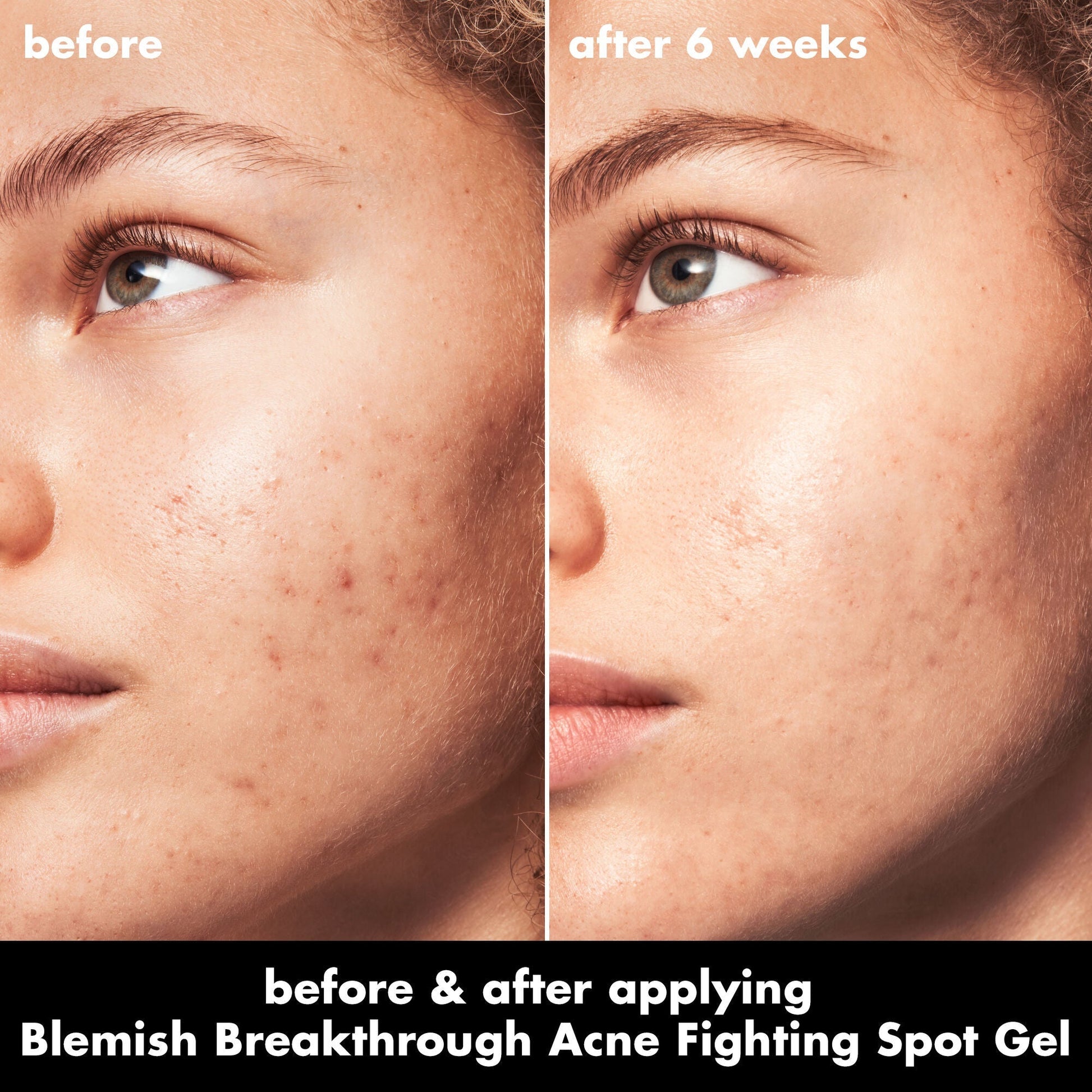 blemish-breakthrough-acne-fighting-spot-gel-a6 0326_EDU_BB_SpotGel_BA_MARLEY.jpg