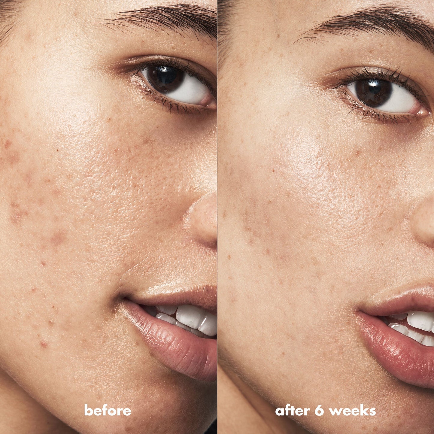 blemish-breakthrough-acne-calming-water-cream-mini-t2 Acne_PDP_Isabella_Before_After_f0d452cd-72f5-4bb8-a6df-0b3cc23143ef.jpg
