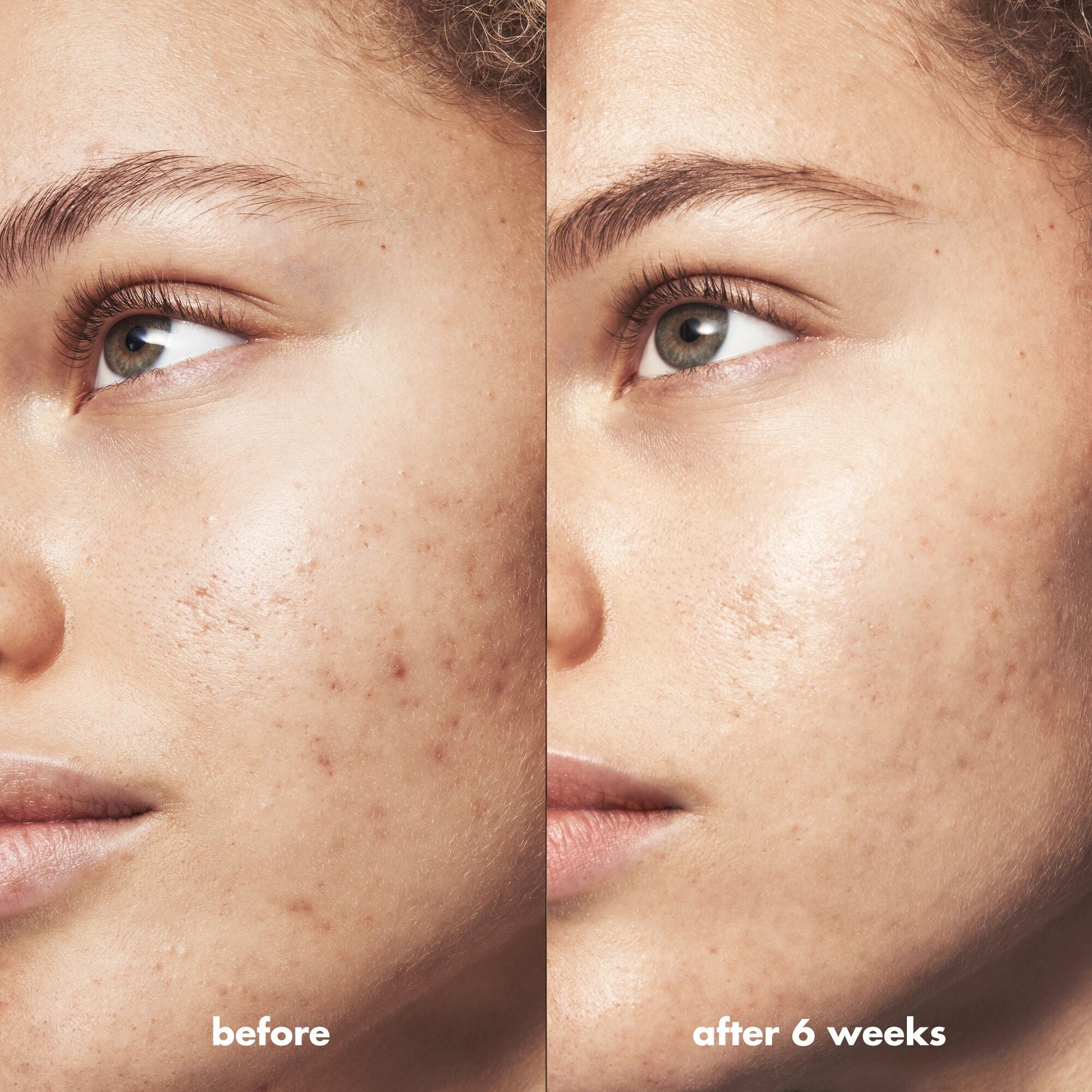 blemish-breakthrough-triple-acid-resurfacing-serum-s5 Acne_PDP_Marley_Before_After_1a95cac5-0af6-43b6-a936-d0bacbdec0bf.jpg
